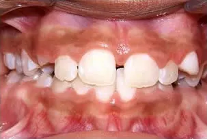 los-angeles-orthodontics-smiles-4-after porcelain veneers smile one after