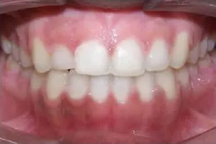 los-angeles-orthodontics-smiles-5-after porcelain veneers smile two after