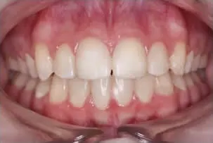 los-angeles-orthodontics-smiles-6-after porcelain veneers smile three after