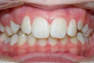 los-angeles-orthodontics-smiles-6-before porcelain veneers smile three before