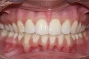 los-angeles-orthodontics-smiles-9-after porcelain veneers smile two after