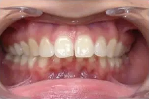 los-angeles-orthodontics-smiles-9-before porcelain veneers smile two before